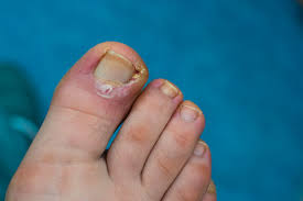 Common Causes and Treatments for Ingrown Toenails
