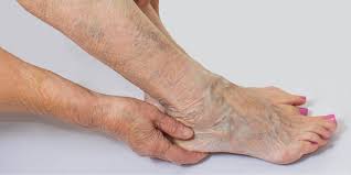 How Do Doctors Diagnose Chronic Venous Insufficiency How Do Doctors Diagnose Chronic Venous Insufficiency?