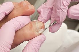 How To Care for Ingrown Toenails To Avoid Surgery