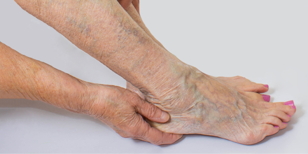 Lifestyle Changes to Reduce the Risk of Varicose Veins
