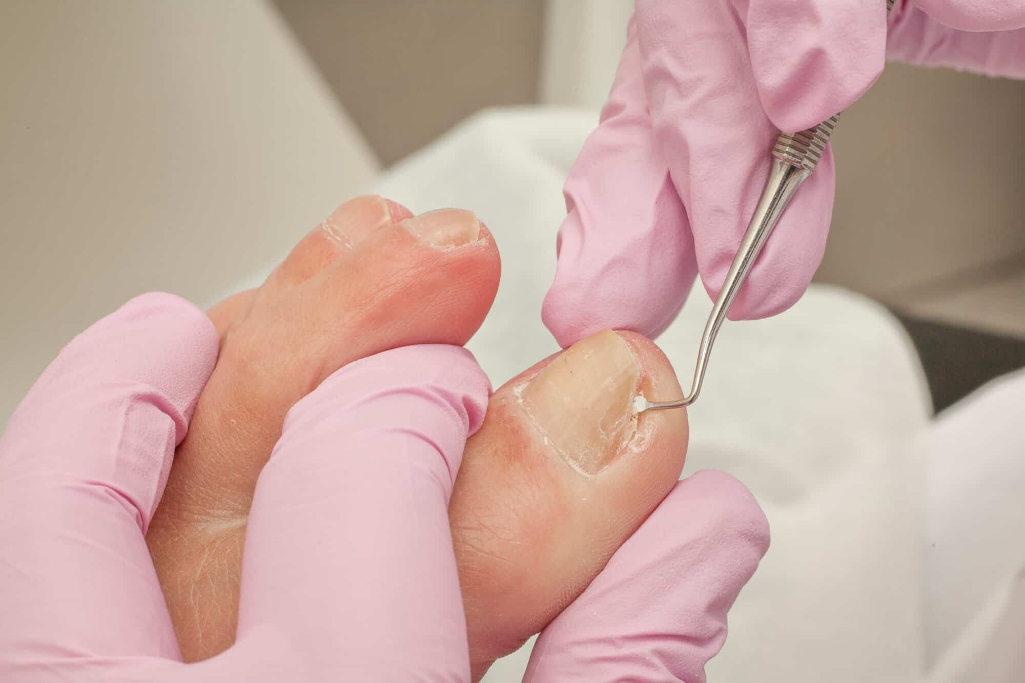 Prevention and Care Techniques for Ingrown Toenails