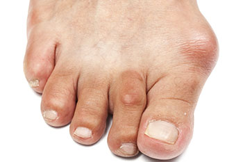 The Connection Between Bunions and Footwear Choices