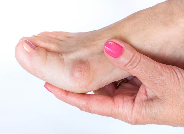 The Long-Term Effects of Untreated Bunions