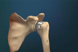 The Role of Orthopedic Surgeons in Shoulder Preservation