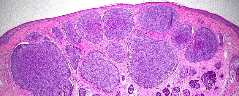 Common Myths About Basal Cell Carcinoma Debunked