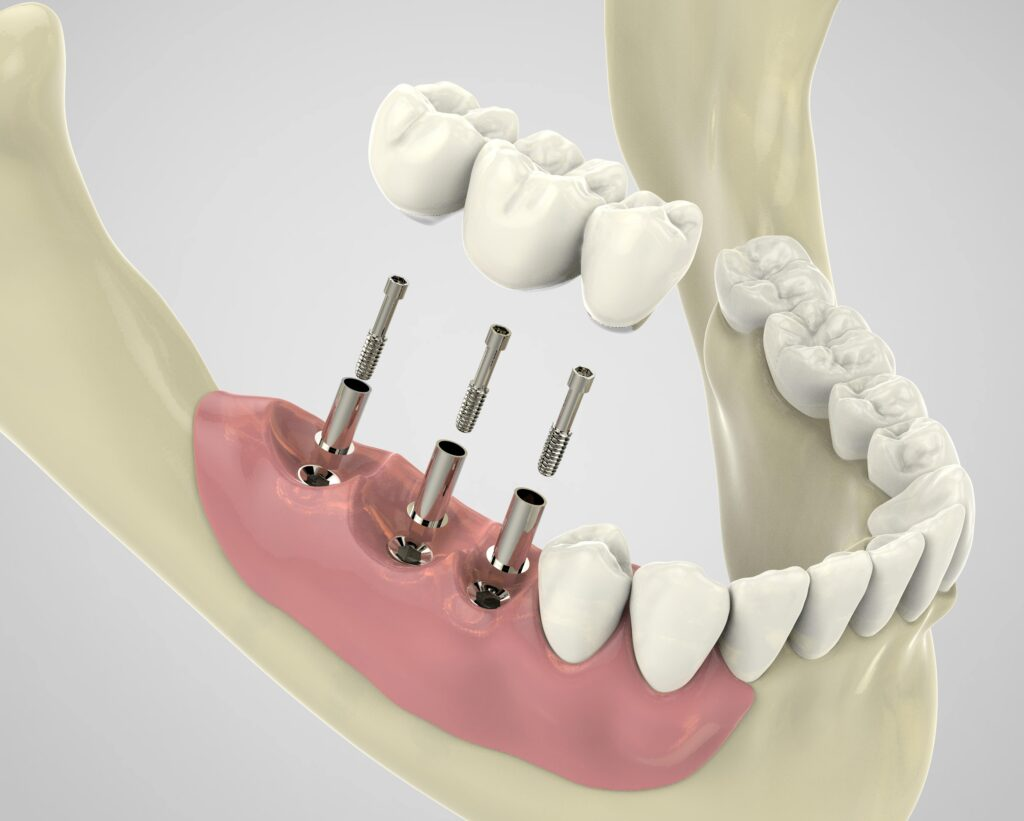 Understanding the Benefits of Endodontic Implants for Tooth Longevity